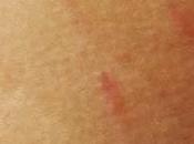 Cuidados antiestrías