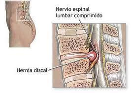herniadisco Los síntomas de la hernia de disco