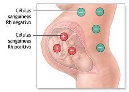 Qué es la enfermedad del Rh