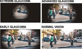 galucoma Tratamientos de glaucoma y ceguera