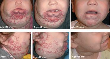 Propanolol oral para hemangiomas infantiles más alla de la fase proliferativa