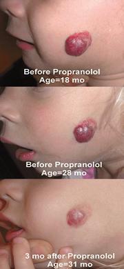 Propanolol oral para hemangiomas infantiles más alla de la fase proliferativa