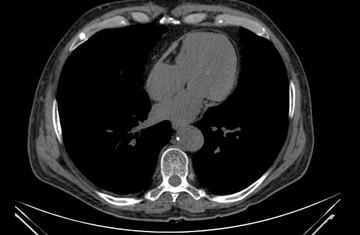 ascitis_artritis_reumatoide/TAC_pericarditis_constrictiva