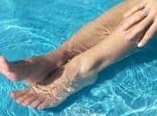 Como evitar nuevas varices verano