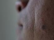 Nuevos lunares piel pueden cáncer
