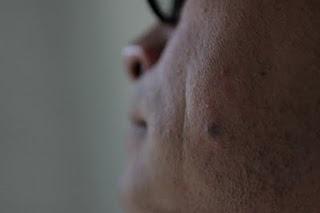 Nuevos lunares en la piel pueden ser cáncer
