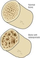 A través de un cuestionario se puede predecir el riesgo de osteoporosis