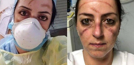 Piel seca por mascarilla Piel seca por culpa de mascarilla quirurgica