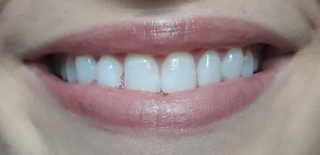 Sonrisa blanca con el tratamiento Dr. Martin Schwarz EXPERT 38%