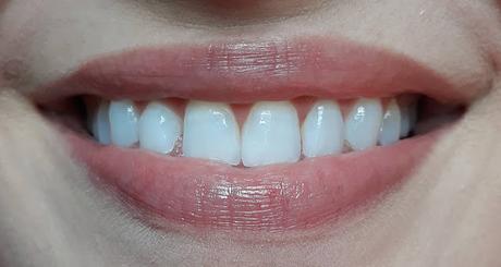 Sonrisa blanca con el tratamiento Dr. Martin Schwarz EXPERT 38% Sonrisa blanca con el tratamiento Dr. Martin Schwarz EXPERT 38%