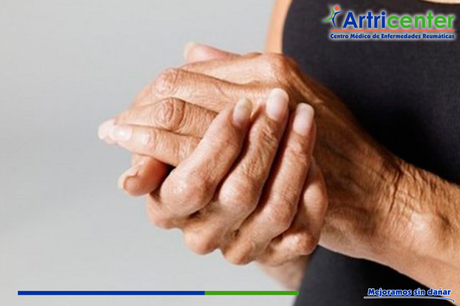 Artrosis de las manos ¿Cómo cuidarnos?