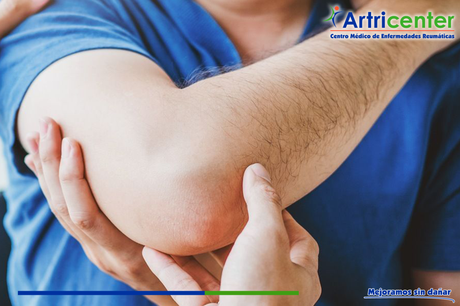 ¿La artritis reumatoide afecta los codos?
