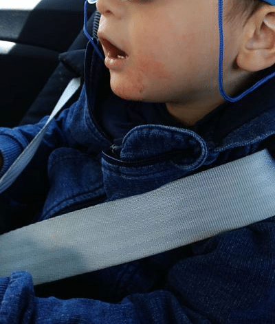 Mi hijo tiene piel atópica 2: La experiencia de 5 años