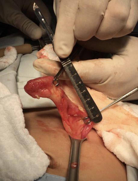 Apendicitis por ultrasonido