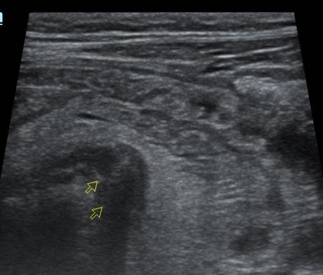 Apendicitis por ultrasonido