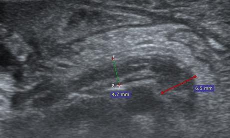 Apendicitis por ultrasonido