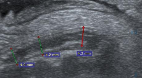 Apendicitis por ultrasonido