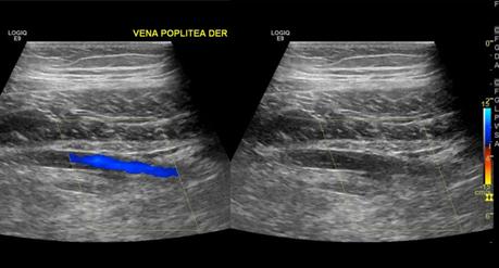 INSUFICIENCIA VENOSA SUPERFICIAL DE VENA SAFENA MAYOR