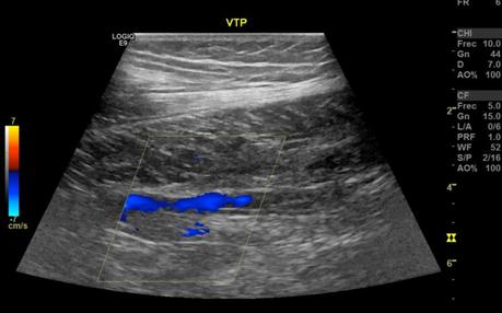 INSUFICIENCIA VENOSA SUPERFICIAL DE VENA SAFENA MAYOR