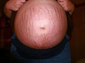 Cómo evitar estrías embarazo