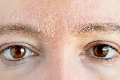 Piel seca después del verano Hidratación imprescindible Piel seca después del verano, Hidratación imprescindible
