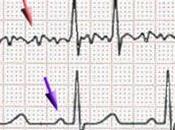 dejamos Fibrilación...