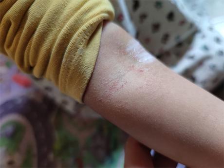 Como cuidar la piel del bebé en invierno: motivos por los que se les irrita la piel con el frío Como cuidar la piel del bebé en invierno: motivos por los que se les irrita la piel con el frío