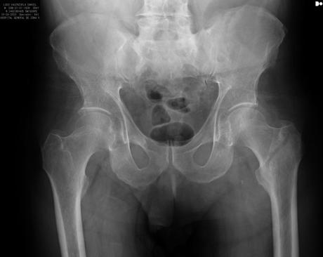 FRACTURA DE CADERA IZQUIERDA FRACTURA DE CADERA IZQUIERDA