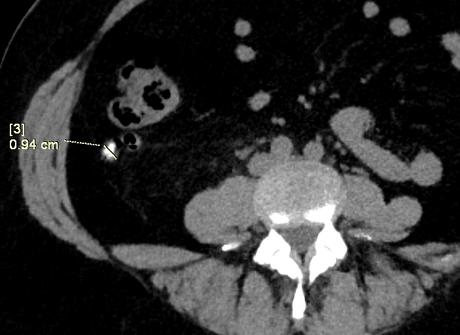 apendicitis por tomografía