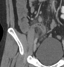 apendicitis por tomografía
