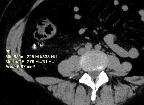 apendicitis por tomografía