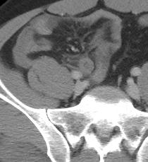 apendicitis por tomografía