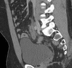 apendicitis por tomografía
