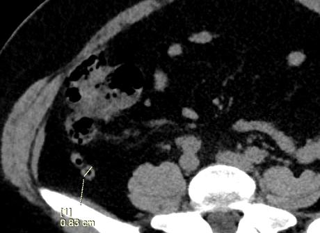 apendicitis por tomografía