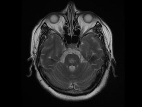 Cambios en la señal de los ganglios basales y la protuberancia, hiperintensas en Flair y con restricción en DW. Sugieren mielinolisis pontina o también llamado sind. De desmielinización osmótica, que buen caso, gracias por las imágenes