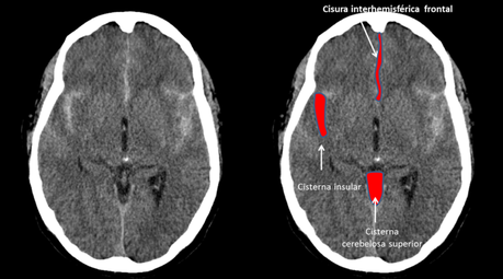 hemorragia subaracnoidea cisternas y cisuras