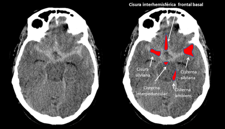 hemorragia subaracnoidea cisternas y cisuras