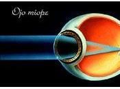 Encuentran Relación entre Miopía Glaucoma