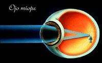 Encuentran Relación entre la Miopía y el Glaucoma