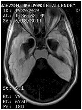 hidrocefalia_congenita_RMN/flair_secuencias_axiales2