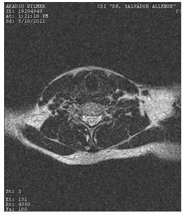 hidrocefalia_congenita_RMN/cervical_t2_axiales2