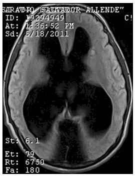 hidrocefalia_congenita_RMN/flair_secuencias_axiales1