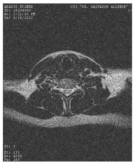 hidrocefalia_congenita_RMN/cervical_t2_axiales1