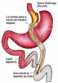 bypass Bypass gástrico para bajar de peso