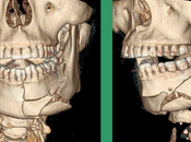 Fractura mandibula enfisema subcutáneo cérvico facial asociado