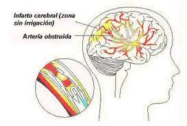 Factores de riesgo para accidentes cerebrovasculares
