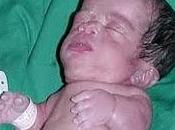 síndrome Antley-Bixler dificultad pediatra