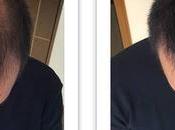 Aceite ricino pelo. Detener caída cabello