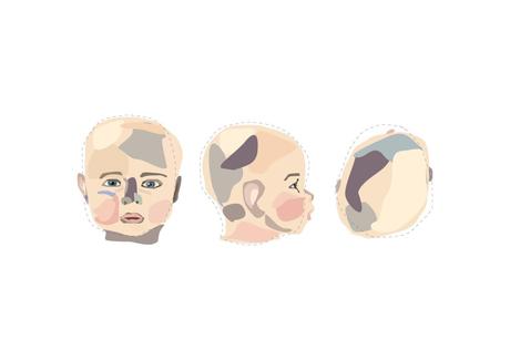 ¿Qué es la plagiocefalia en los bebés y cómo se puede prevenir?