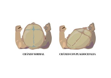 ¿Qué es la plagiocefalia en los bebés y cómo se puede prevenir?